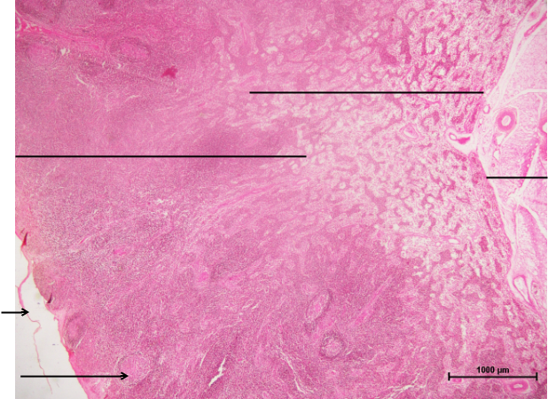Lymph Node 1