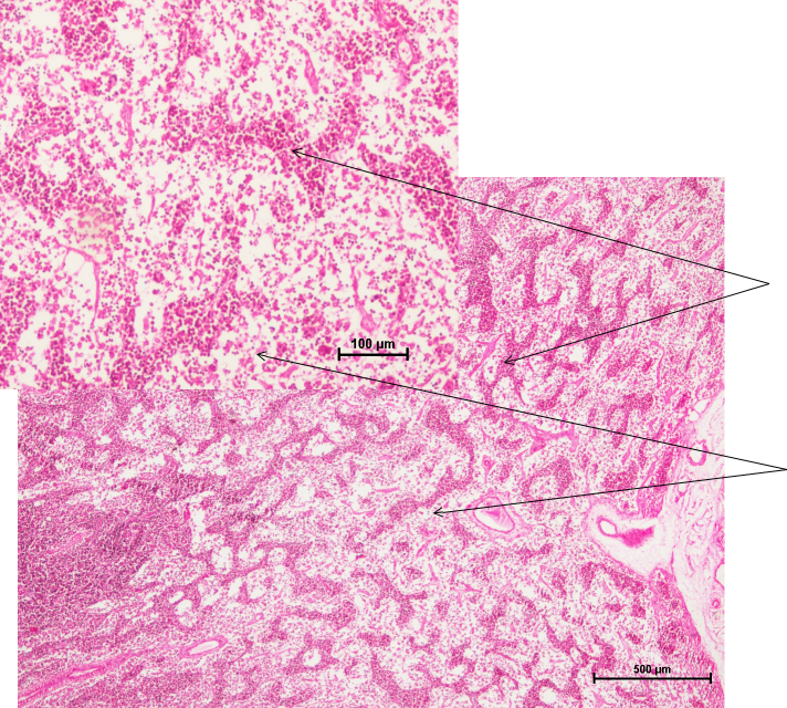 Lymph Node 5