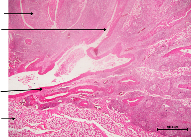 Tonsil 1